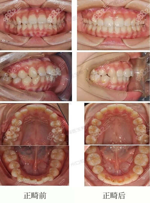 广州圣贝口腔深覆盖牙齿矫正案例前后对比照