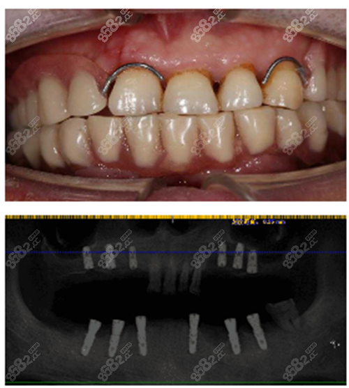牙齿缺失6颗的我,在南京美奥口腔种植牙后对比照片分享