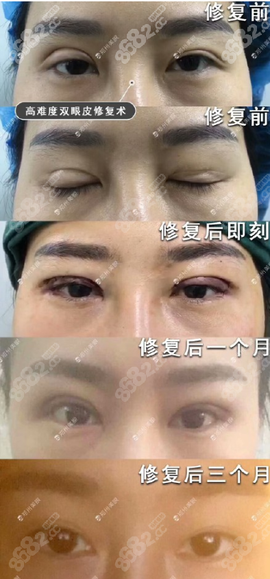 眼部失败手术修复 正文 以下是多年来田国静医生所修复的双眼皮失败