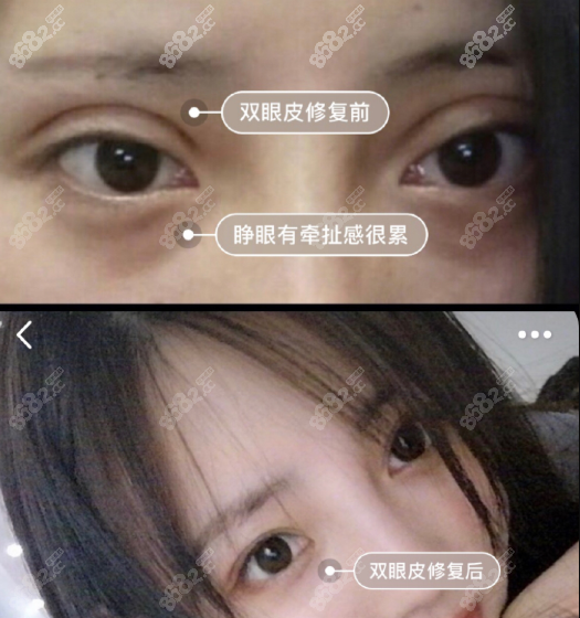 都说广州潘贰修复失败双眼皮案例自然如初眼就是价格贵不