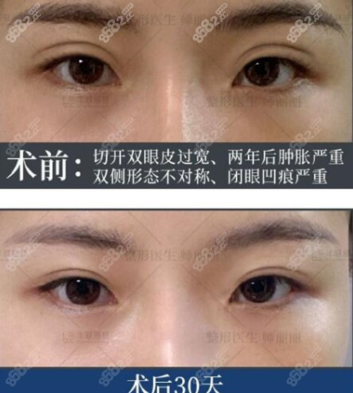 北京丰联丽格师丽丽双眼皮修复前后对比图
