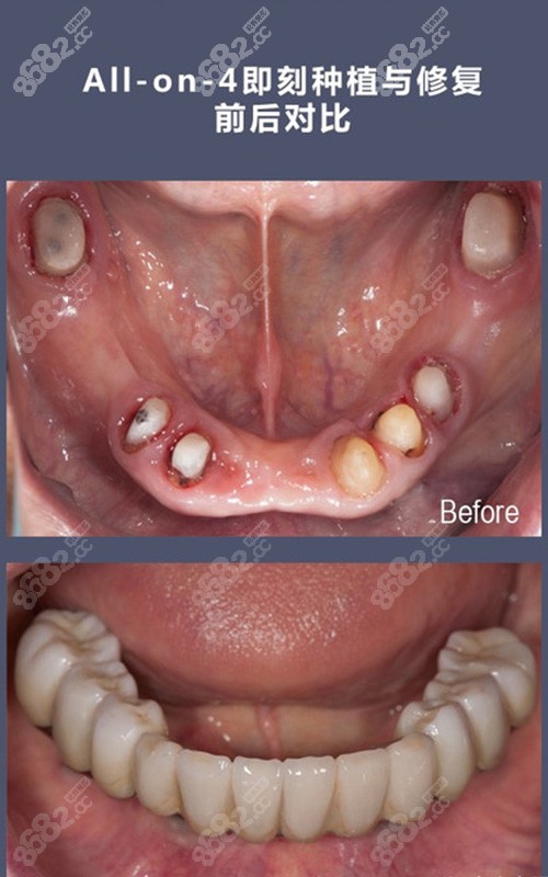 上海维乐口腔即刻种植与修复前后对比