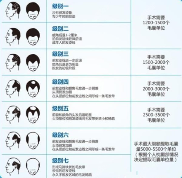 找吴巍医生植发2000毛囊准备3万够吗