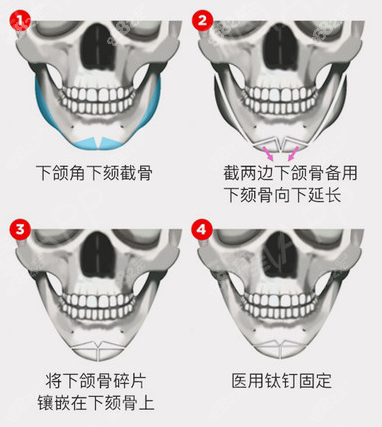 李志海v-line下颏成形术-w型截骨术