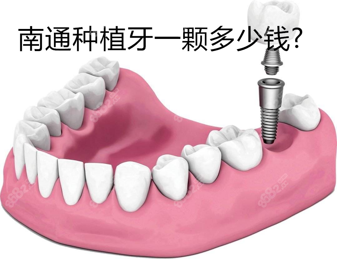 了份南通种植牙价格表,想知道南通口腔医院种植牙费用的朋友们必看,不