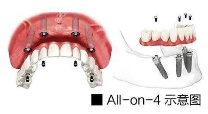 对比照片 正文 一般如果做全口半固定种植牙,也就是所谓的覆盖义齿
