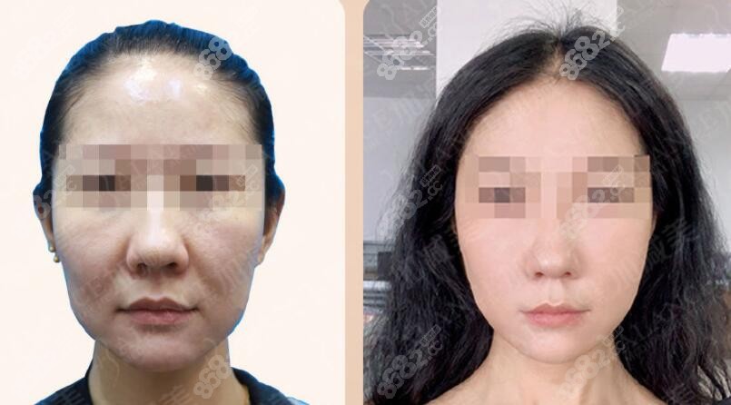 正文↑↑这是我在北京加减美做全脸拉皮手术三个月前后对比照片~做的
