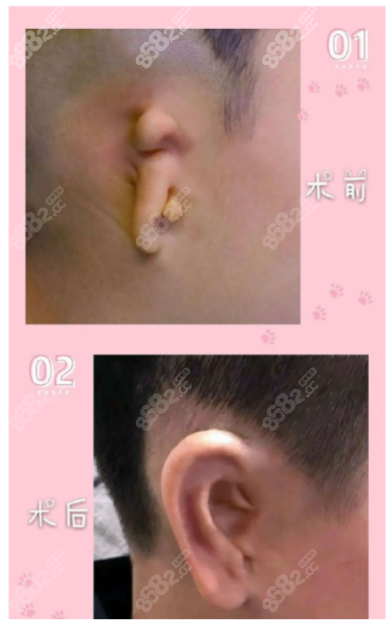 首页 对比照片 耳部对比照 正文 这张图片可以看出,刘暾医生在做耳朵