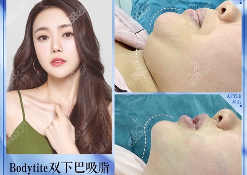 深圳军科医疗美容陈海医生双下巴吸脂术前术后对比图