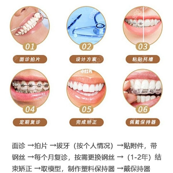 海口口腔医院牙齿矫正过程