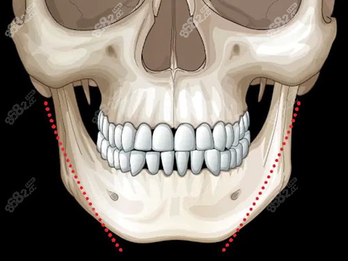 下颌角内收的样子