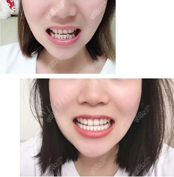 郑州天后口腔医院牙齿矫正怎么样从矫牙后用户的反馈分析