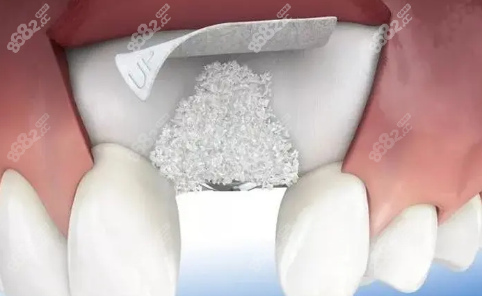 种植牙植骨粉多长时间恢复种植牙植的骨粉是什么材料
