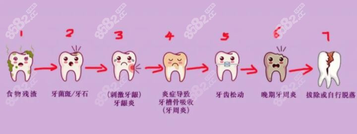 牙周炎的演变过程