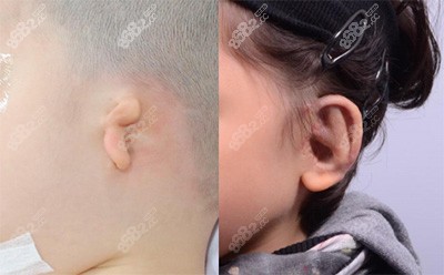 耳朵畸形几岁适合做再造?韩国普罗菲耳外耳再造手术好吗