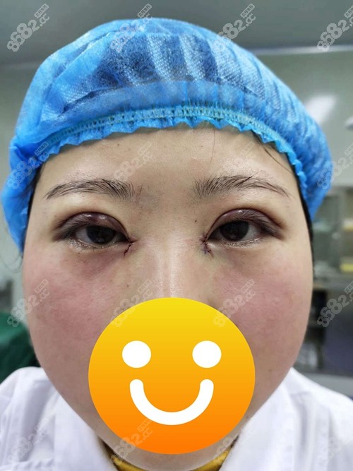 株洲韩美陶正全切双眼皮手术后第三天