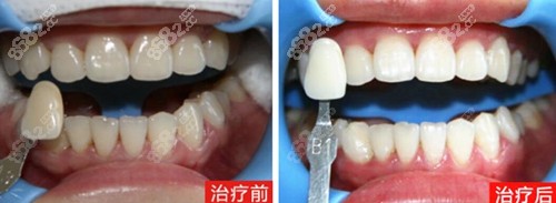 三亚口腔医院向亚东牙齿美白案例