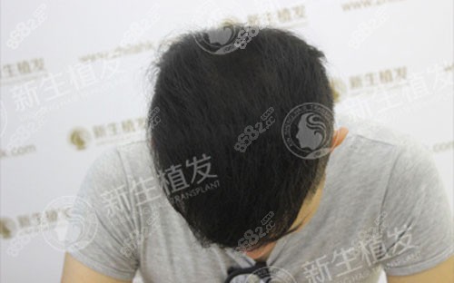 为改善脱发秃顶我去上海新生做头发种植拿到一份植发价格