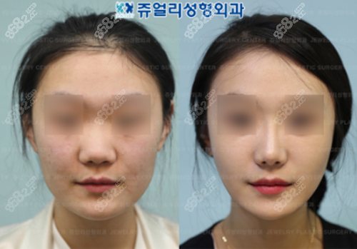 韩国珠儿丽鼻翼肥大整形怎么样?从案例看术后效果