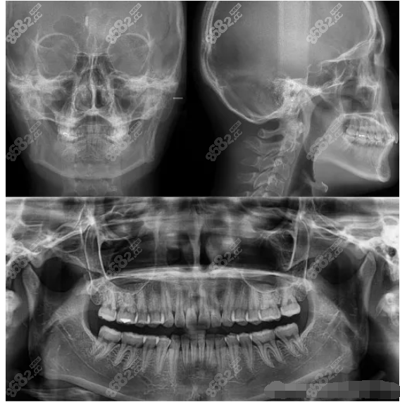 面部x光片看脸型图片