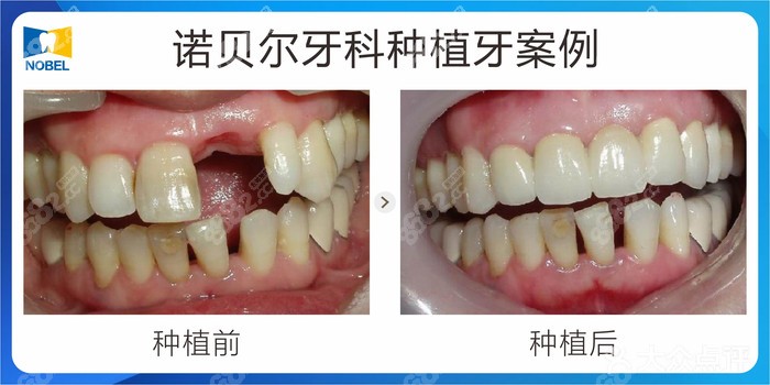 西安诺贝尔口腔种植牙案例