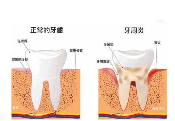 找啟貝口腔馬躍醫生做了激光牙周閉合刮治牙周炎不疼了