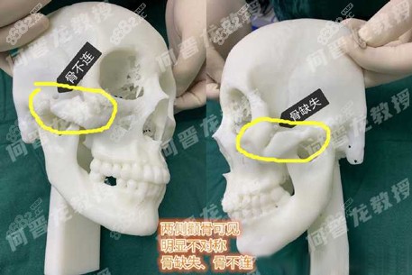 上海時光何晉龍案例解析下頜骨等頜面整形失敗修復的方式