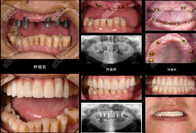 北京斯迈尔口腔种植牙案例效果很不错