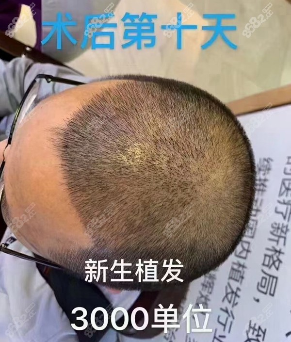 新生头顶植发3000单位术后10