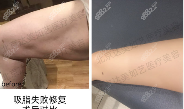 北京达美如艺谷廷敏大腿活细胞纤针吸脂修复术案例集分享