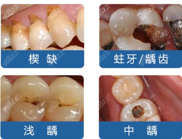 合肥靚美的3mm樹脂補牙一招幫你搞定