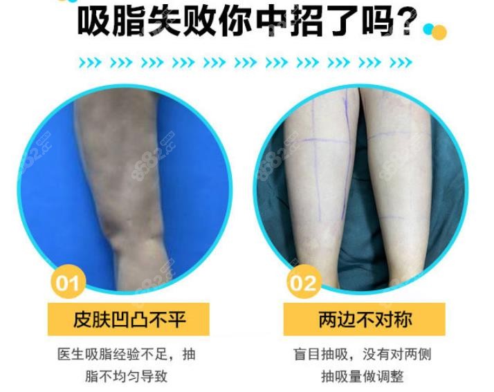 北京私立医院做大腿吸脂凹陷修复好的专家价格贵不贵呢?