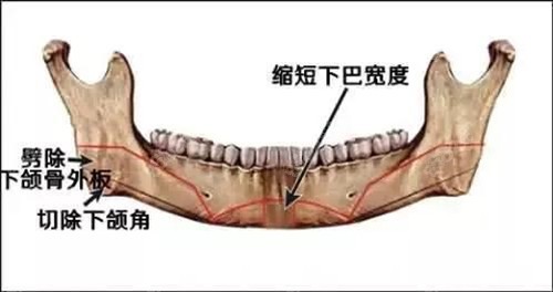 李志海医生的磨骨是什么风格给了那么多人削下颌角的勇气