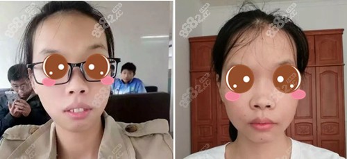 成都華西口腔正頜正畸手術費用公佈,發現價格不貴效果還好