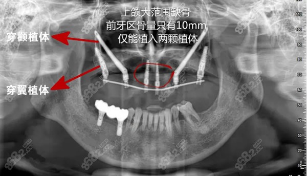 劉院長種植時,還分別在兩側5,6號牙區位置做了外提升,先在上頜竇側壁