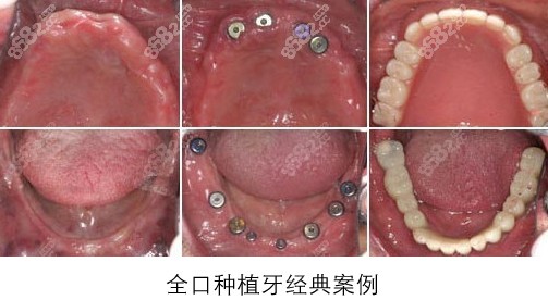 國內全口種植牙的費用一般在多少錢這有種滿口牙的價格表