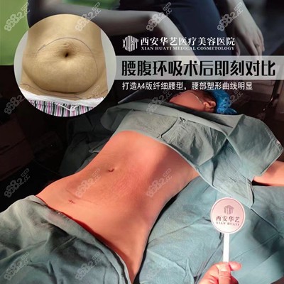 看完西安華藝醫療美容醫院腰腹吸脂效果圖後感覺技術真牛