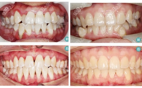 成都團圓口腔牙齒矯正前後對比照片