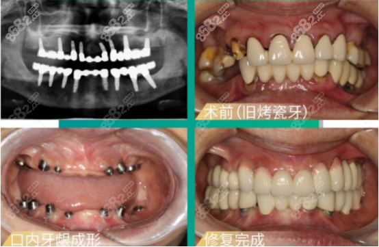 公示北京维恩口腔医院种植牙和正畸价格,来看需要多少钱,牙齿矫正