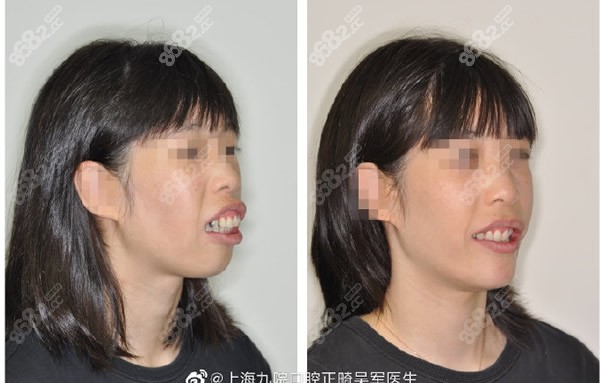 3分钟了解上海九院牙齿矫正价目表,看地包天正畸需要多少钱