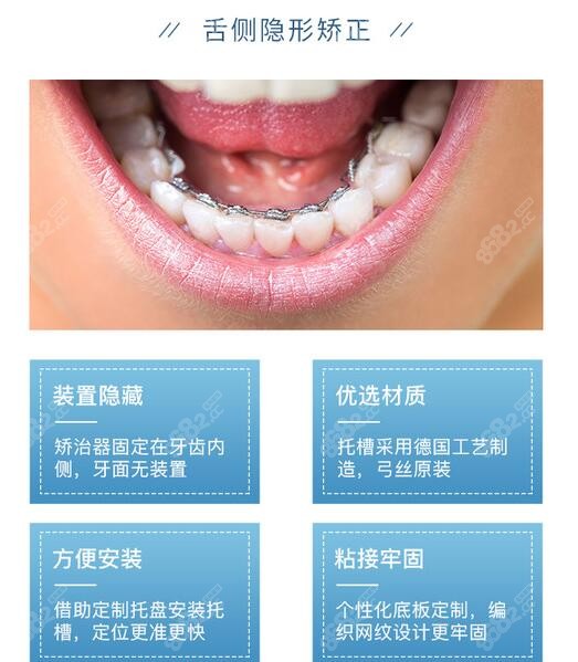 广州牙齿矫正大概花费多少钱?有2021广州隐形牙套价格表就ok