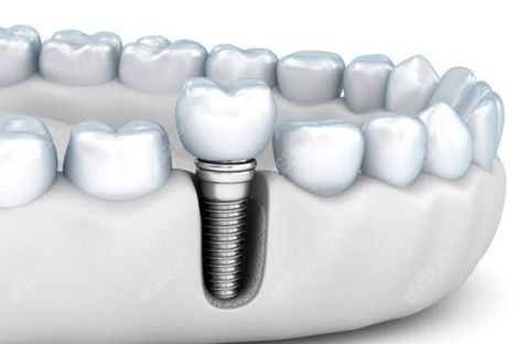 南通美奥口腔的价格怎么样,做韩国奥齿泰种植牙收费高吗