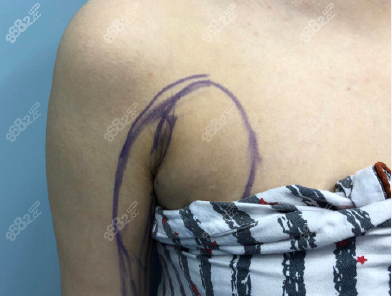 腋窝副乳手术切口图图片