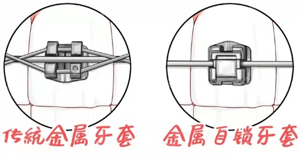 傳統託槽與自鎖託槽結紮絲的區別