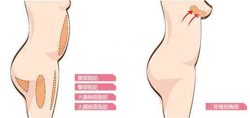 具優勢↓↓↓ 1,曹衛剛 ★隆胸優勢: 如果你想做自體脂肪豐胸手術的話