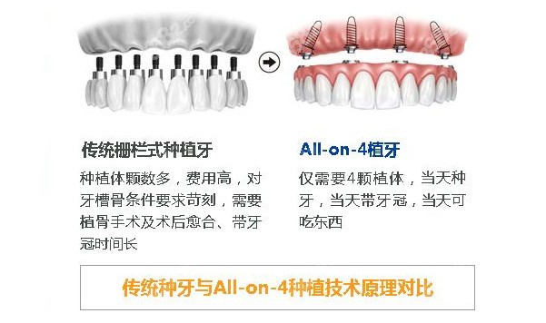 揭曉長沙全口種植牙價格美奧和德韓做全口種植牙都比較好