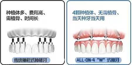 种牙与镶牙有什么区别哪个好一些?从优缺点使用寿命来说说