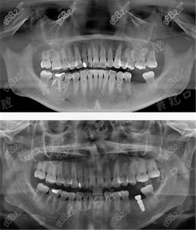 北京爵冠口腔種植牙前後ct