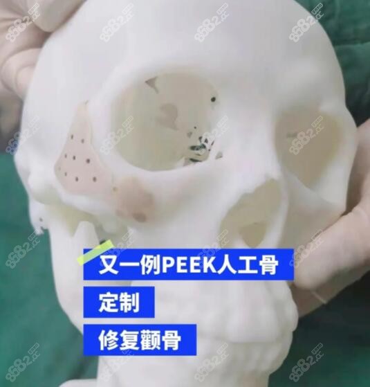 3d人工骨墊顴骨修復價格及peek材料修復顴骨使用壽命,你造嗎?