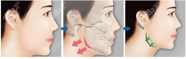国字脸做下颌角磨骨手术步骤中有说截下颌骨从哪里开刀哦